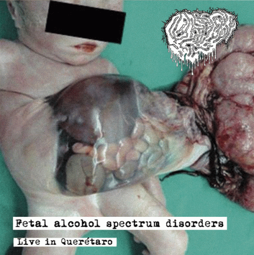 Fetal Deformity : Fetal Alcohol Spectrum Disorders - Live in Querétaro